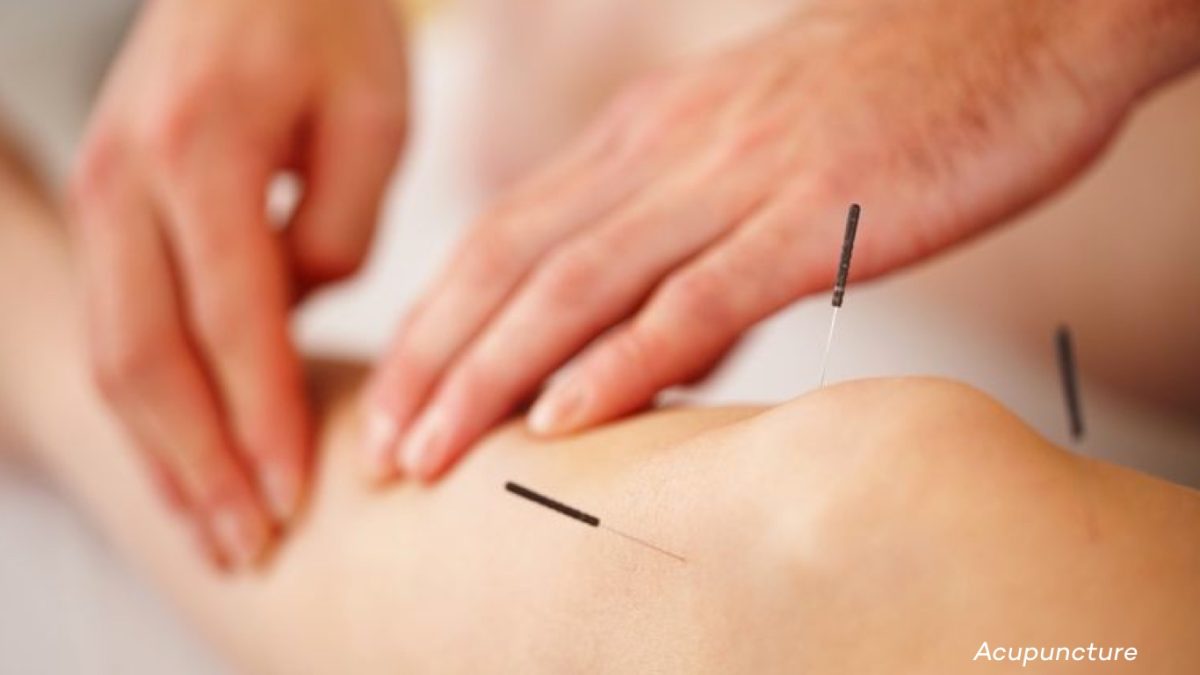 When To Have Acupuncture for Fertility - A Comprehensive Guide