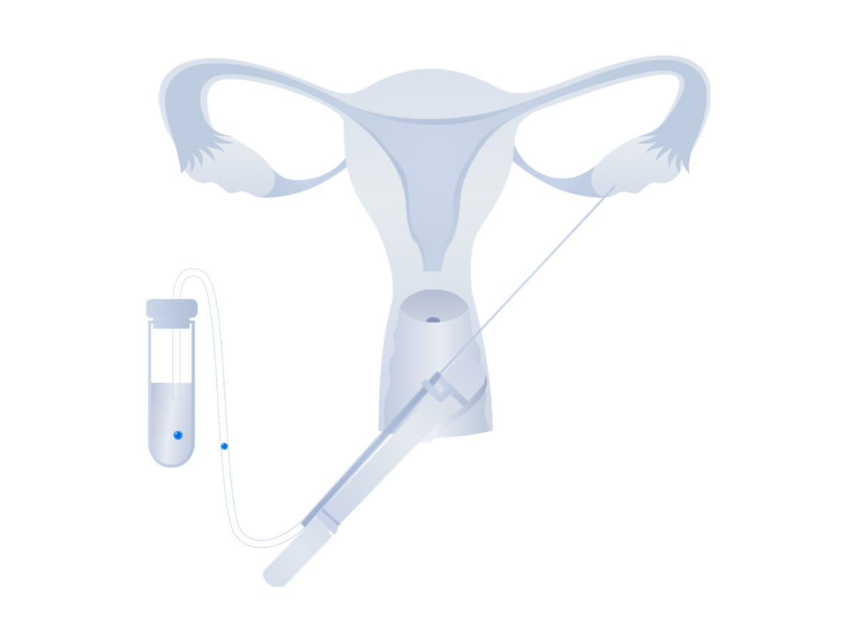 IVF Egg Retrieval: Process, Procedure, Recovery, Risks, and More