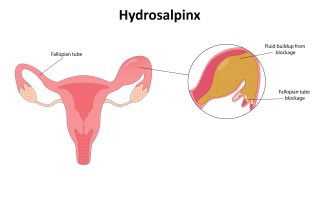Hydrosalpinx Symptoms, Causes, Treatment, and IVF Success Rates