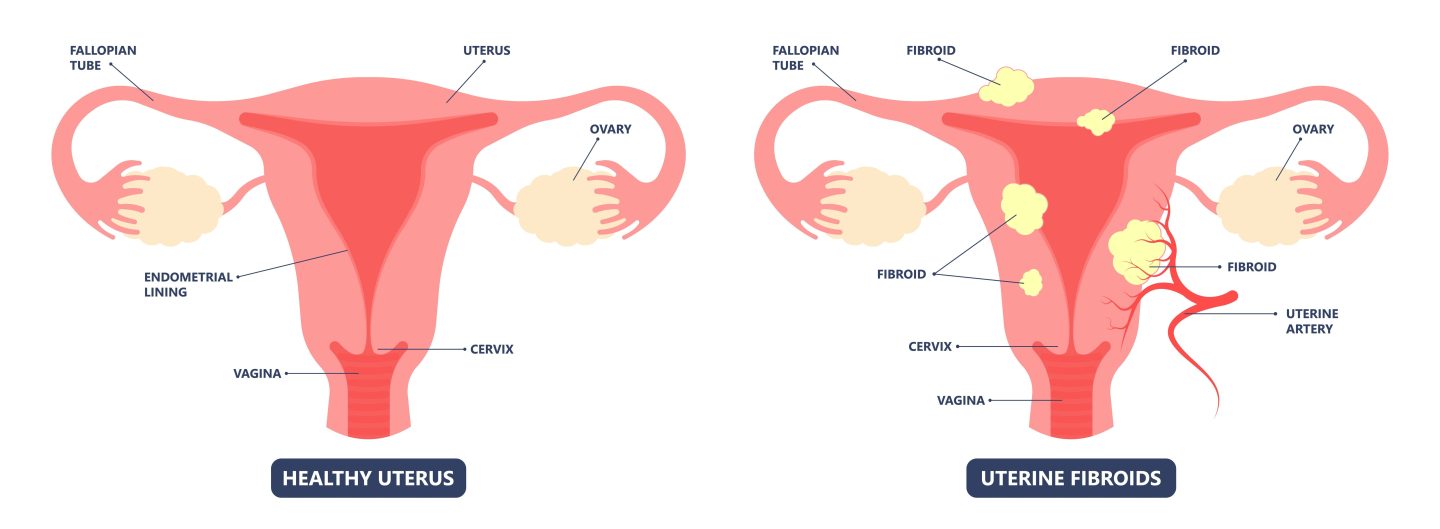 Picture of Image result for hysterectomy genetic testing for women