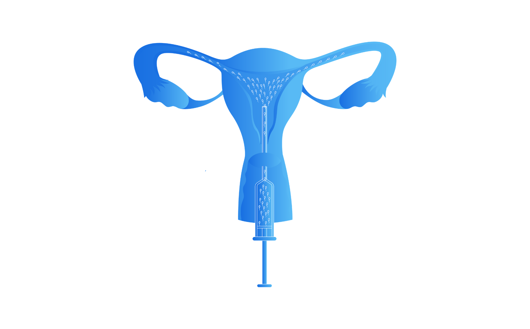 Artificial Insemination Types, Process, Costs and More image